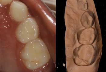 Maxillary teeth