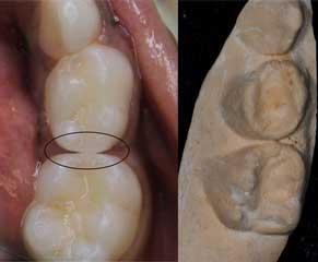 Mandibular teeth