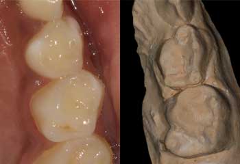 Maxillary teeth